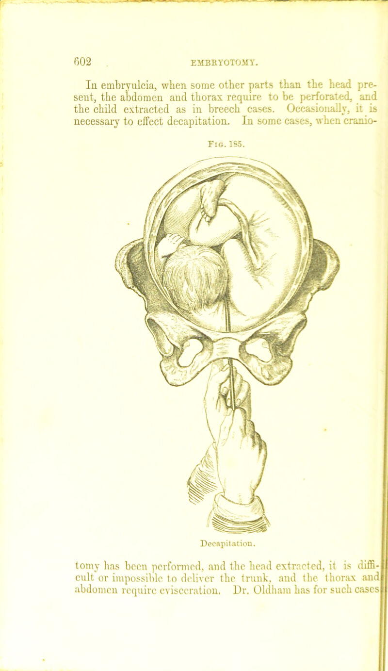 In embryulcia, when some other parts than the head pre- sent, the abdomen and thorax require to be perforated, and the child extracted as in breech cases. Occasionally, it is necessary to effect decapitation. In some cases, when cranio- Fig. 185. Decapitation. tomy has been performed, and the head extracted, it is diffi- cult or impossible to deliver the trunk, and the thorax and abdomen require evisceration. Dr. Oldham has for such cases