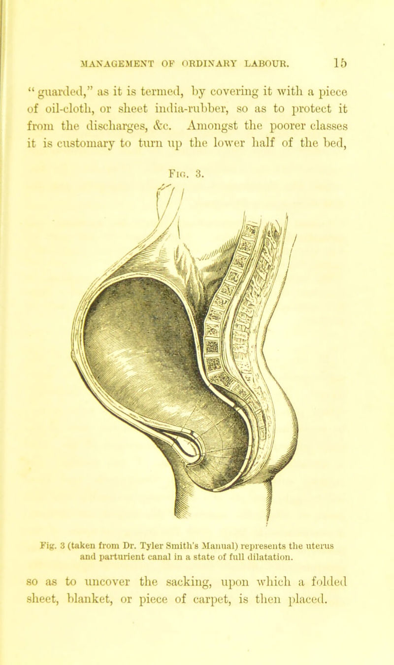 “ guarded,” as it is termed, by covering it with a piece of oil-clotli, or sheet india-rubber, so as to protect it from the discharges, &e. Amongst the poorer classes it is customary to turn up the lower half of the bed, Fio. 3. Fig. 3 (taken from Dr. Tyler Smith's Manual) represents the uterus and parturient canal in a state of full dilatation. so as to uncover the sacking, upon which a folded sheet, blanket, or piece of carpet, is then placed.