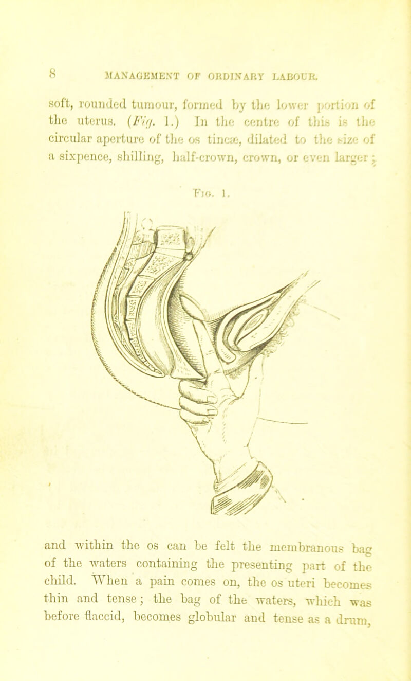 soft, rounded tumour, formed bjr the lower portion of tlie uterus. {F-ig. 1.) In the centre of this is the circular aperture of the os tinea.-, dilated to the size of a sixpence, shilling, half-crown, crown, or even larger; Fio. 1. and within the os can be felt the membranous barr C1 of the waters containing the presenting part of the child. When a pain comes on, the os uteri becomes thin and tense; the bag of the waters, which was before flaccid, becomes globular and tense as a drum,