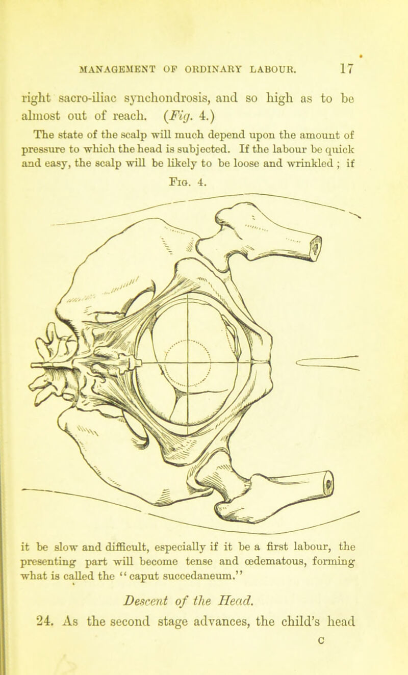 right sacro-iliac synchondrosis, and so high as to he almost out of reach. {Fig. 4.) The state of the scalp will much depend upon the amount of pressure to which the head is subjected. If the labour be quick and easy, the scalp will be likely to he loose and wrinkled ; if Fig. 4. ^ 1 . . ^V\ \ ? mV v \\ dLJ/j it be slow and difficult, especially if it be a first labour, the presenting part will become tense and cedematous, forming what is called the “ caput succedaneum.” Descent of the Head. 24. As the second stage advances, the child’s head c