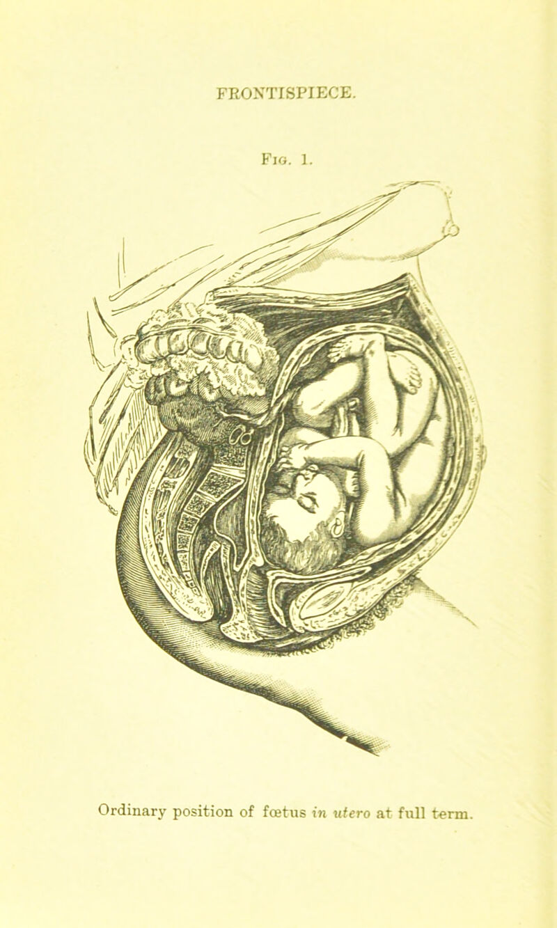 FRONTISPIECE. Fig. 1. Ordinary position of foetus in utero at full term.