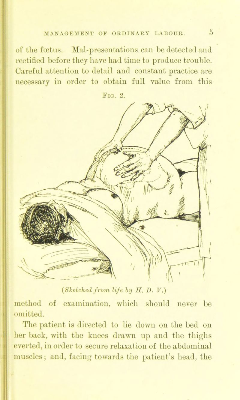 of tlie fuitus. Mal-preseiitiitioiis can be detected and rectified before they have had time to produce trouble. Careful attention to detail and constant practice are necessary in order to obtain full value from this Fia. 2. {Sketched from life by II. D. V.) method of examination, which should never be omitted. The patient is directed to lie down on the bed on her back, with the knees drawn up and the thighs everted, in order to secure relaxation of the abdominal muscles; and, facing towards the patient’s head, the