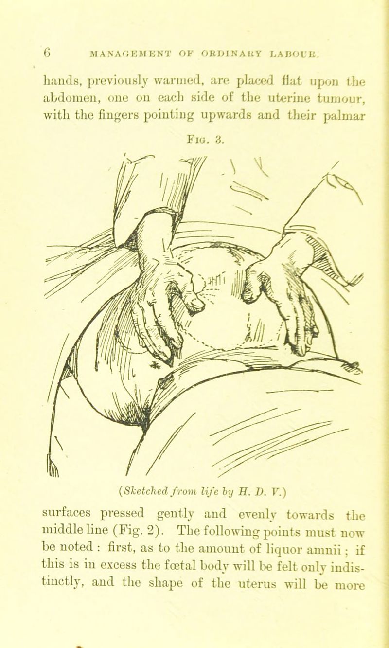 M AN A«KM KNT OK OKl>INAItY I.ABOIK. G liiuids, previouKly wanned, are placed flat upon llie abdomen, one on eacli side of the uterine tumour, with the fingers pointing upwards and their palmar Fio. 3. 1 (Sketched from life hy H. D. T.) surfaces pressed gently and evenly towards the i middle line (Fig. 2). The follomng points must now j be noted : first, as to the amount of liquor amnii; if ' this is in excess the foetal body will lie felt only indis- I tinctly, and the shape of the uterus will be more ’