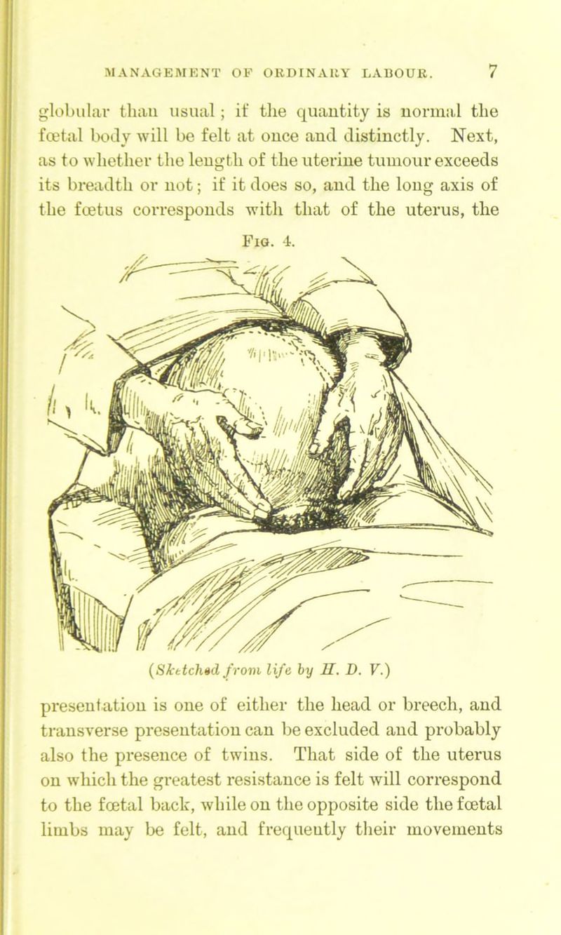 gloliular than usual; it' the quantity is normal the foetal body will be felt at once and distinctly. Next, as to whether the length of the uterine tumour exceeds its breadth or not; if it does so, and the long axis of the foetus corresponds with that of the uterus, the Fig. 4. presentation is one of either the head or breech, and transverse presentation can be excluded and probably also the presence of twins. That side of the uterus on which the greatest resistance is felt will correspond to the foetal back, while on the opposite side the foetal limbs may be felt, and frequently tlieir movements