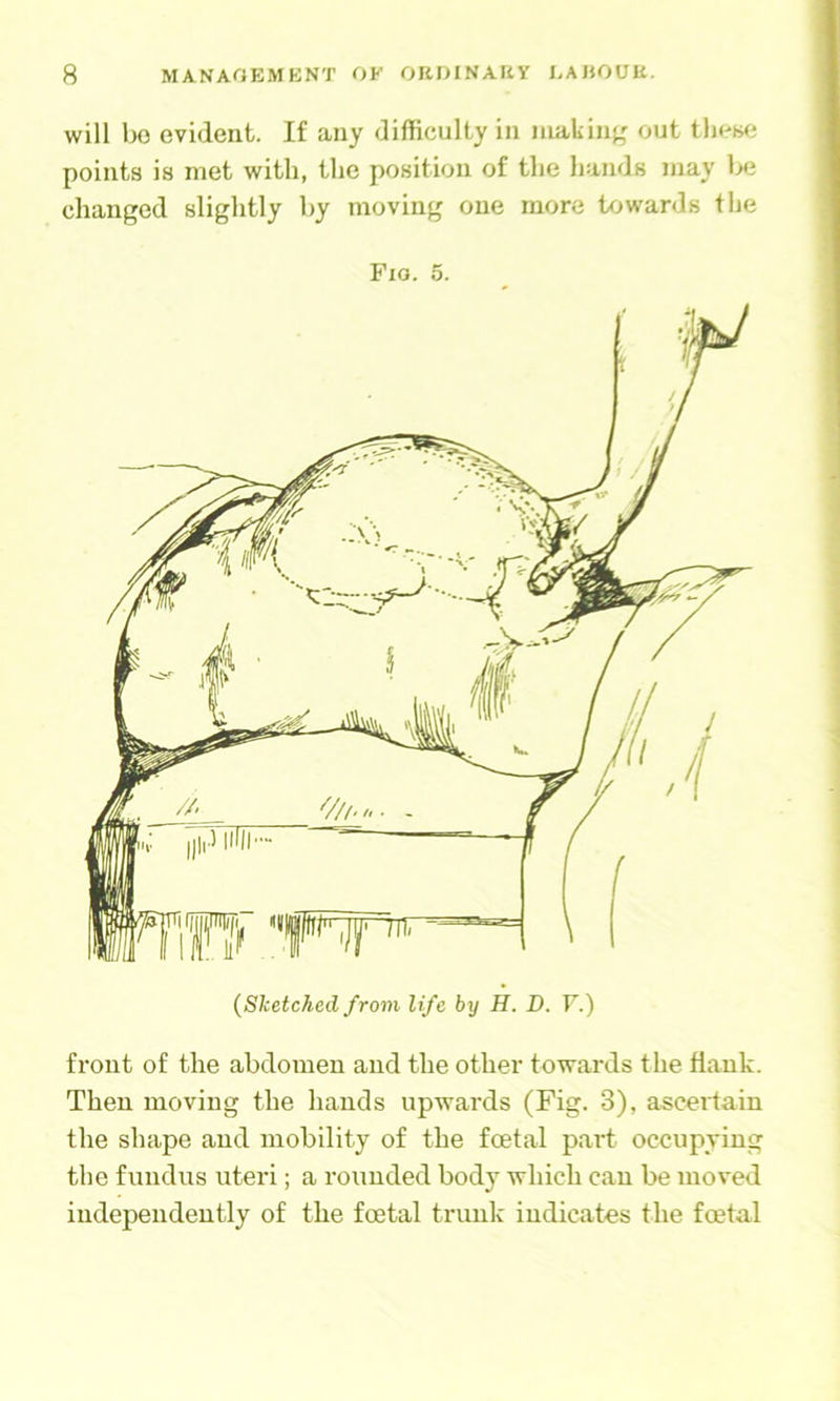 will bo evident. If any difficulty in inaliin^' out tliewj points is met with, the position of the hands may be changed slightly by moving one more towards the Fio. 5. front of the abdomen and the other towards the Hank. Then moving the hands upwards (Fig. 3), ascertain the shape and mobility of the fcetal paid occupying the fundus uteri; a rounded body which can be moved independently of the foetal trunk indicates the foetal
