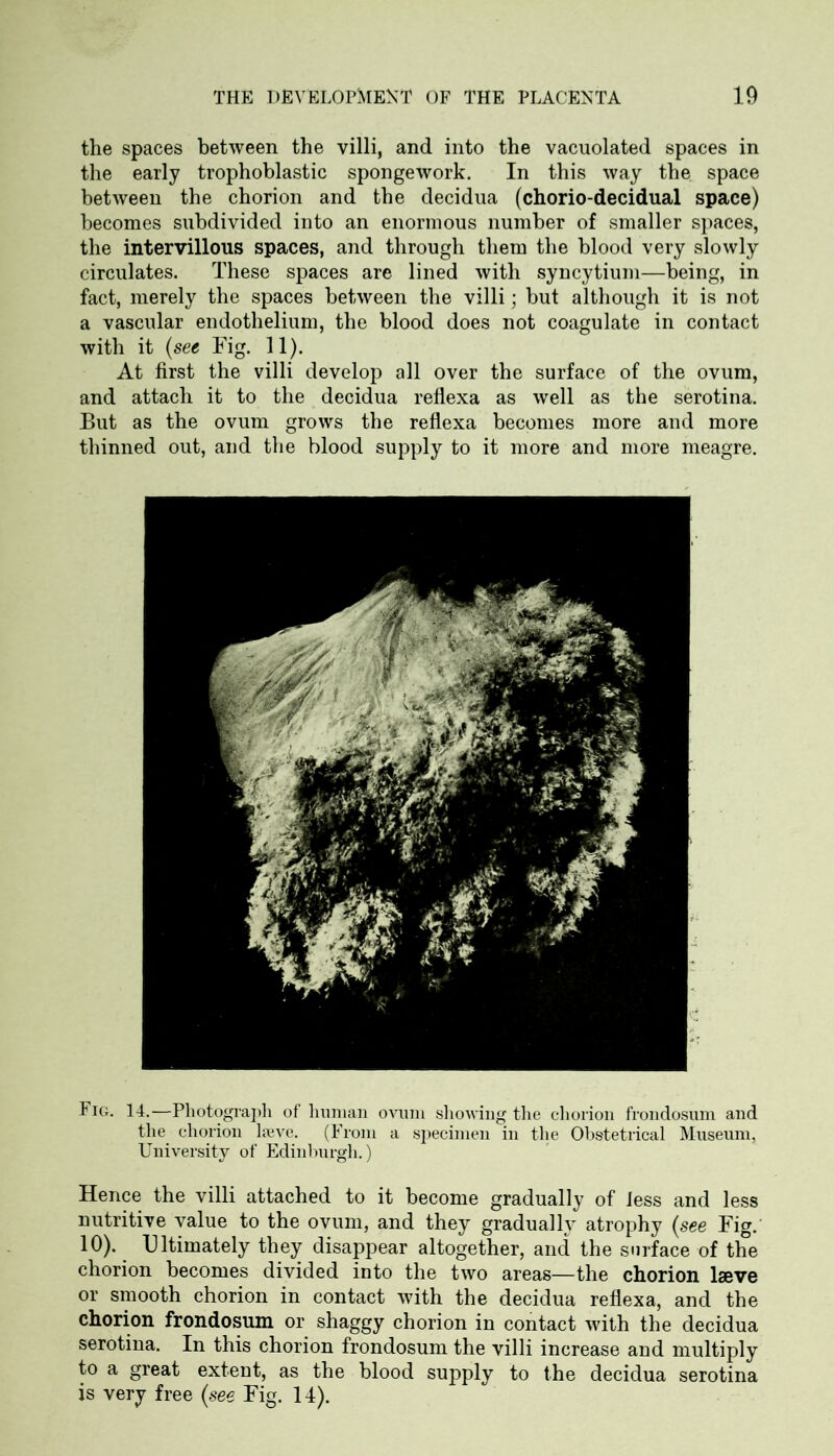 the spaces between the villi, and into the vacuolated spaces in the early trophoblastic spongework. In this way the space between the chorion and the decidua (chorio-decidual space) becomes subdivided into an enormous number of smaller spaces, the intervillous spaces, and through them the blood very slowly circulates. These spaces are lined with syncytium—being, in fact, merely the spaces between the villi; but although it is not a vascular endothelium, the blood does not coagulate in contact with it (see Fig. 11). At first the villi develop all over the surface of the ovum, and attach it to the decidua reflexa as well as the serotina. But as the ovum grows the reflexa becomes more and more thinned out, and the blood supply to it more and more meagre. Fig. 14.—Photograph of human ovum showing the chorion frondosum and the chorion l?eve. (From a specimen in the Obstetrical Museum, University of Edinburgh.) Hence the villi attached to it become gradually of less and less nutritive value to the ovum, and they gradually atrophy (see Fig. 10). Ultimately they disappear altogether, and the surface of the chorion becomes divided into the two areas—the chorion lseve or smooth chorion in contact with the decidua reflexa, and the chorion frondosum or shaggy chorion in contact with the decidua serotina. In this chorion frondosum the villi increase and multiply to a great extent, as the blood supply to the decidua serotina is very free {see Fig. 14).