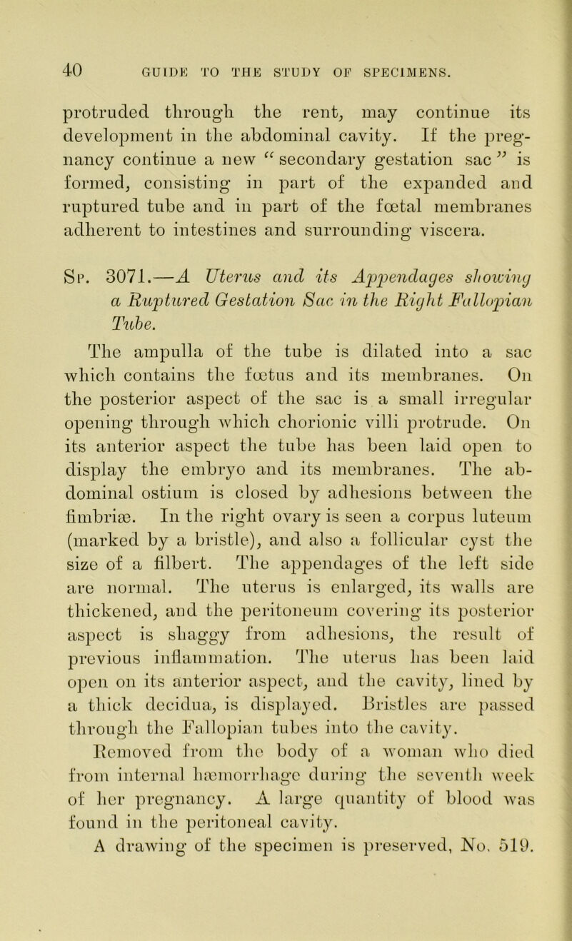 protruded through the rent, may continue its development in the abdominal cavity. If the preg- nancy continue a new a secondary gestation sac ” is formed, consisting in part of the expanded and ruptured tube and in part of the foetal membranes adherent to intestines and surrounding viscera. Sp. 3071.—A Uterus and its Appendages showing a Ruptured Gestation Sac in the Right Fallopian Tube. The ampulla of the tube is dilated into a sac which contains the foetus and its membranes. On the posterior aspect of the sac is a small irregular opening through which chorionic villi protrude. On its anterior aspect the tube has been laid open to display the embryo and its membranes. The ab- dominal ostium is closed by adhesions between the fimbriae. In the right ovary is seen a corpus luteum (marked by a bristle), and also a follicular cyst the size of a filbert. The appendages of the left side are normal. The uterus is enlarged, its walls are thickened, and the peritoneum covering its posterior aspect is shaggy from adhesions, the result of previous inflammation. The uterus has been laid open on its anterior aspect, and the cavity, lined by a thick decidua, is displayed. Bristles are passed through the Fallopian tubes into the cavity. Removed from the body of a woman who died from internal haemorrhage during the seventh week of her pregnancy. A large quantity of blood was found in the peritoneal cavity. A drawing of the specimen is preserved, No. 519.