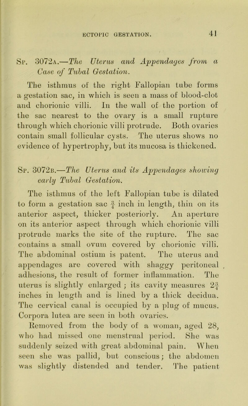 Sp. 3072a.—The Uterus and Appendages from a Case of Tubal Gestation. The isthmus of the rig'lit Fallopian tube forms a gestation sac, in which is seen a mass of blood-clot and chorionic villi. In the wall of the portion of the sac nearest to the ovary is a small rupture through which chorionic villi protrude. Both ovaries contain small follicular cysts. The uterus shows no evidence of hypertrophy, but its mucosa is thickened. Sp. 3072b.—The Uterus and its Appendages showing early Tubed Gestation. The isthmus of the left Fallopian tube is dilated to form a gestation sac f inch in length, thin on its anterior aspect, thicker posteriorly. An aperture on its anterior aspect through which chorionic villi protrude marks the site of the rupture. The sac contains a small ovum covered by chorionic villi. The abdominal ostium is patent. The uterus and appendages are covered with shaggy peritoneal adhesions, the result of former inflammation. The uterus is slightly enlarged ; its cavity measures 2-J inches in length and is lined by a thick decidua. The cervical canal is occupied by a plug of mucus. Corpora lutea are seen in both ovaries. Removed from the body of a woman, aged 28, who had missed one menstrual period. She was suddenly seized with great abdominal pain. When seen she was pallid, but conscious; the abdomen was slightly distended and tender. The patient