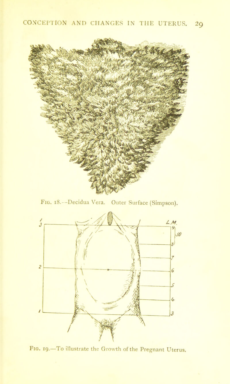 CONCEPTION AND CHANGES IN THE UTERUS. 2g Fig. 18.--Decidua Vera. Outer Surface (Simpson). V S ~ V \ \ t-.M Fig. ig.—To illustrate the Growth of the Pregnant Uterus.