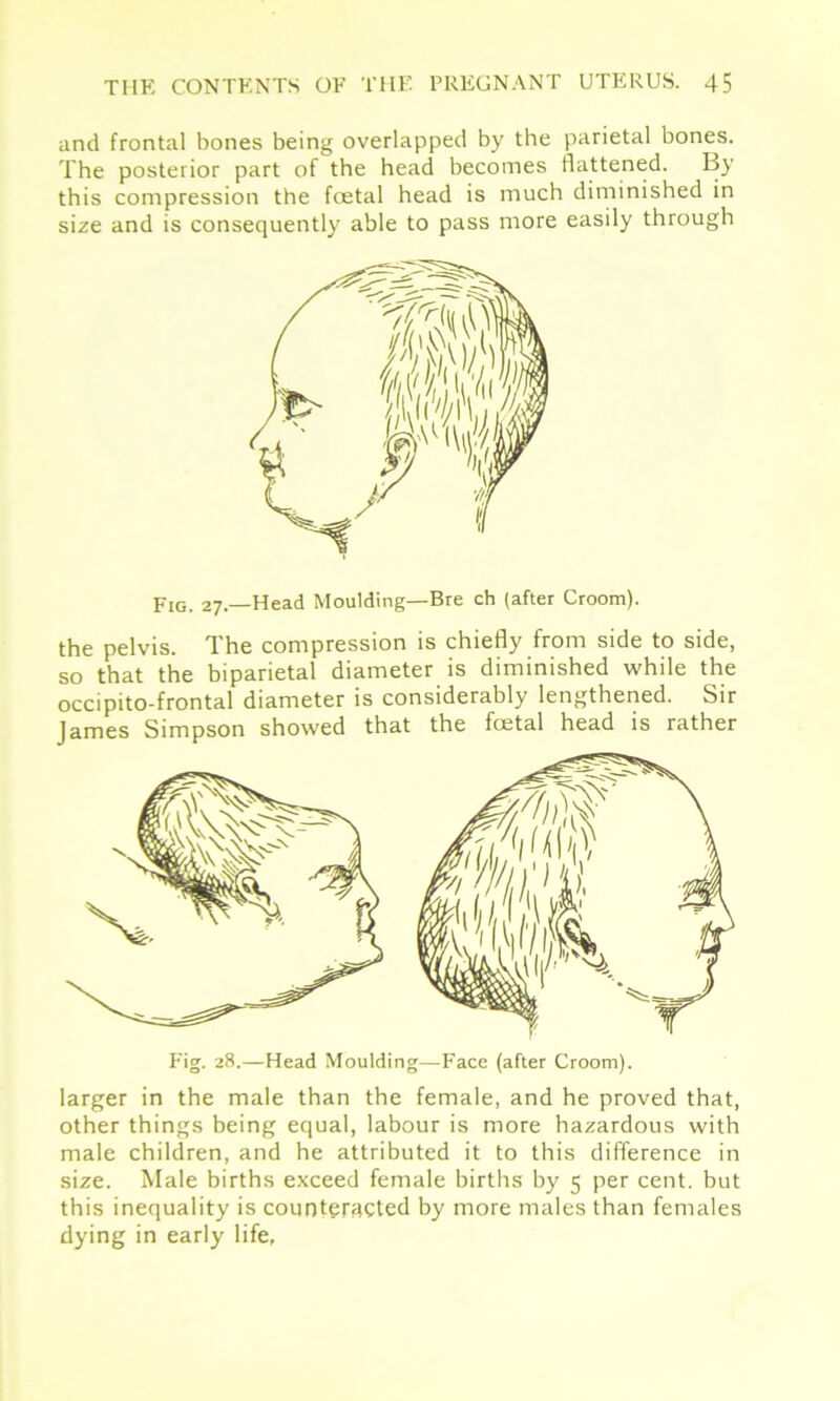 and frontal bones being overlapped by the parietal bones. The posterior part of the head becomes flattened. By this compression the foetal head is much diminished in size and is consequently able to pass more easily through Fig. 27.—Head Moulding—Bre ch (after Croom). the pelvis. The compression is chiefly from side to side, so that the biparietal diameter is diminished while the occipito-frontal diameter is considerably lengthened. Sir James Simpson showed that the foetal head is rather larger in the male than the female, and he proved that, other things being equal, labour is more hazardous with male children, and he attributed it to this difference in size. Male births exceed female births by 5 per cent, but this inequality is counteracted by more males than females dying in early life. Fig. 28.—Head Moulding—Face (after Croom).