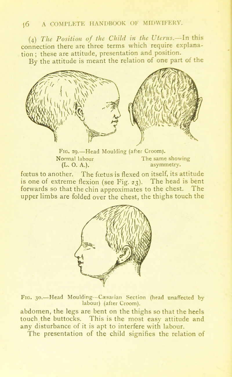 (4) The Position of the Child in the Uterus.—In this connection there are three terms which require explana- tion ; these are attitude, presentation and position. By the attitude is meant the relation of one part of the Fig. 29.—Head Moulding (after Croom). Normal labour The same showing (L. O. A.). asymmetry. foetus to another. The foetus is flexed on itself, its attitude is one of extreme flexion (see Fig. 23). The head is bent forwards so that the chin approximates to the chest. The upper limbs are folded over the chest, the thighs touch the Fig. 30.—Head Moulding—Casarian Section (head unaffected by labour) (after Croom). abdomen, the legs are bent on the thighs so that the heels touch the buttocks. This is the most easy attitude and any disturbance of it is apt to interfere with labour. The presentation of the child signifies the relation of