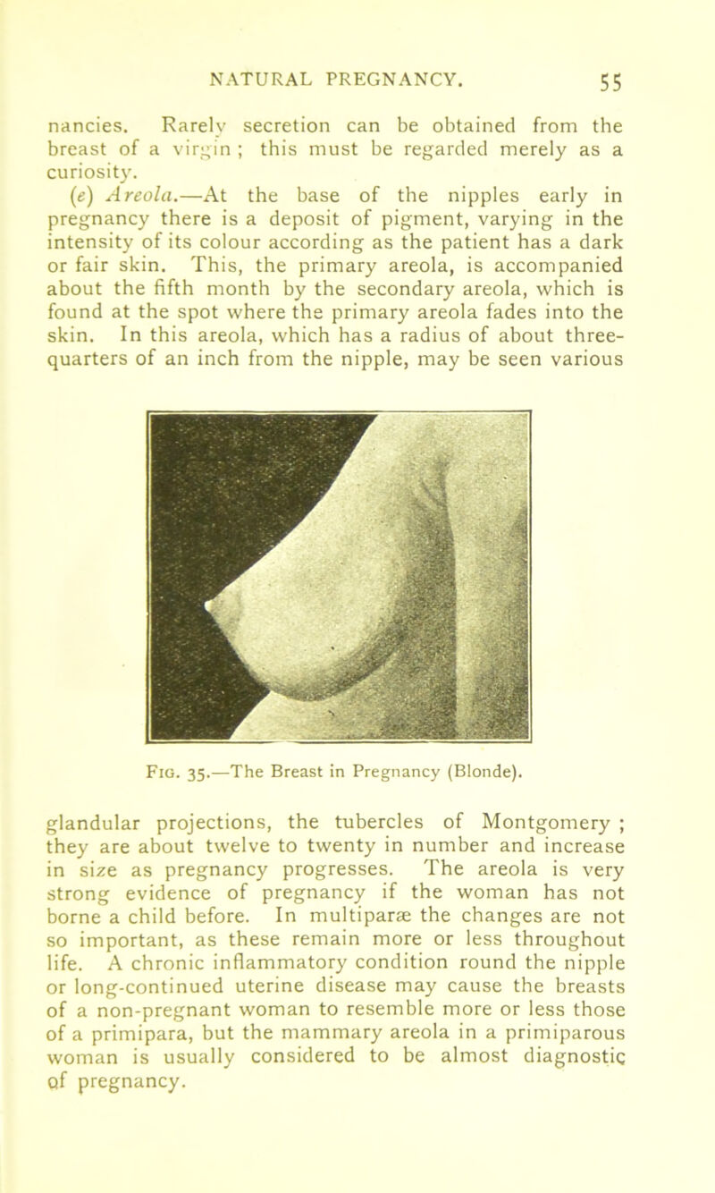 nancies. Rarely secretion can be obtained from the breast of a virgin ; this must be regarded merely as a curiosity. (e) Areola.—At the base of the nipples early in pregnancy there is a deposit of pigment, varying in the intensity of its colour according as the patient has a dark or fair skin. This, the primary areola, is accompanied about the fifth month by the secondary areola, which is found at the spot where the primary areola fades into the skin. In this areola, which has a radius of about three- quarters of an inch from the nipple, may be seen various Fig. 35.—The Breast in Pregnancy (Blonde). glandular projections, the tubercles of Montgomery ; they are about twelve to twenty in number and increase in size as pregnancy progresses. The areola is very strong evidence of pregnancy if the woman has not borne a child before. In multiparse the changes are not so important, as these remain more or less throughout life. A chronic inflammatory condition round the nipple or long-continued uterine disease may cause the breasts of a non-pregnant woman to resemble more or less those of a primipara, but the mammary areola in a primiparous woman is usually considered to be almost diagnostic of pregnancy.