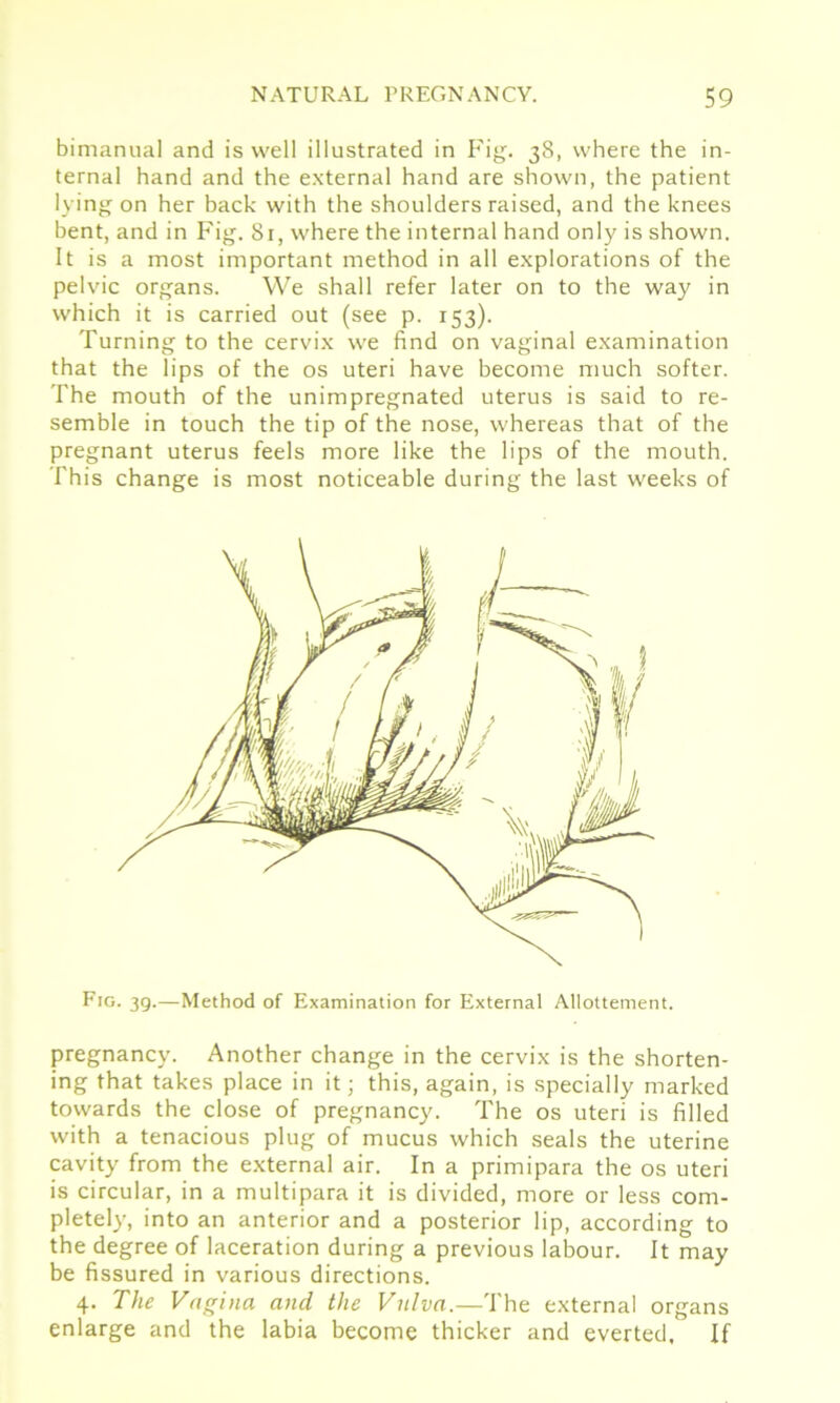 bimanual and is well illustrated in Fig. 38, where the in- ternal hand and the external hand are shown, the patient lying on her back with the shoulders raised, and the knees bent, and in Fig. 81, where the internal hand only is shown. It is a most important method in all explorations of the pelvic organs. We shall refer later on to the way in which it is carried out (see p. 153). Turning to the cervix we find on vaginal examination that the lips of the os uteri have become much softer. The mouth of the unimpregnated uterus is said to re- semble in touch the tip of the nose, whereas that of the pregnant uterus feels more like the lips of the mouth. This change is most noticeable during the last weeks of Fig. 3g.—Method of Examination for External Allottement. pregnancy. Another change in the cervix is the shorten- ing that takes place in it; this, again, is specially marked towards the close of pregnancy. The os uteri is filled with a tenacious plug of mucus which seals the uterine cavity from the external air. In a primipara the os uteri is circular, in a multipara it is divided, more or less com- pletely, into an anterior and a posterior lip, according to the degree of laceration during a previous labour. It may be fissured in various directions. 4. The Vagina and the Vulva.—The external organs enlarge and the labia become thicker and everted. If
