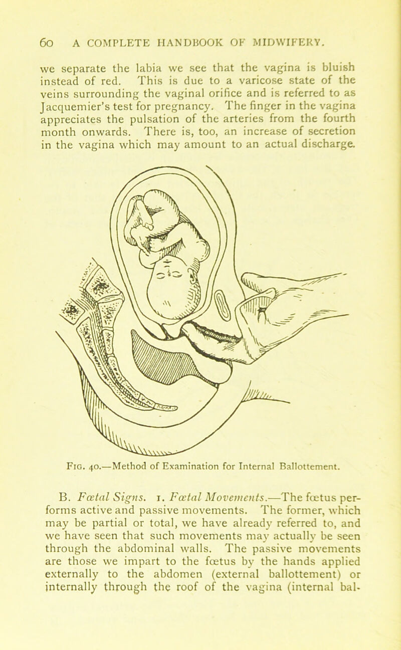 we separate the labia we see that the vagina is bluish instead of red. This is due to a varicose state of the veins surrounding the vaginal orifice and is referred to as Jacquemier’s test for pregnancy. The finger in the vagina appreciates the pulsation of the arteries from the fourth month onwards. There is, too, an increase of secretion in the vagina which may amount to an actual discharge. Fig. 40.—Method of Examination for Internal Ballottement. B. Foetal Signs. 1. Foetal Movements.—The foetus per- forms active and passive movements. The former, which may be partial or total, we have already referred to, and we have seen that such movements may actually be seen through the abdominal walls. The passive movements are those we impart to the foetus by the hands applied externally to the abdomen (external ballottement) or internally through the roof of the vagina (internal bal-