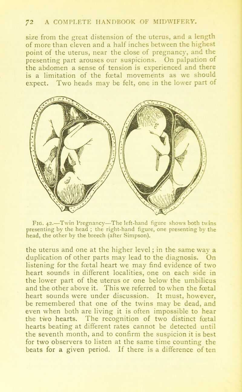 size from the great distension of the uterus, and a length of more than eleven and a half inches between the highest point of the uterus, near the close of pregnancy, and the presenting part arouses our suspicions. On palpation of the abdomen a sense of tension is experienced and there is a limitation of the foetal movements as we should expect. Two heads may be felt, one in the lower part of Fig. 42.-—Twin Pregnancy—The left-hand figure shows both twins presenting by the head ; the right-hand figure, one presenting by the head, the other by the breech (after Simpson). the uterus and one at the higher level; in the same way a duplication of other parts may lead to the diagnosis. On listening for the foetal heart we may find evidence of two heart sounds in different localities, one on each side in the lower part of the uterus or one below the umbilicus and the other above it. This we referred to when the fcetal heart sounds were under discussion. It must, however, be remembered that one of the twins may be dead, and even when both are living it is often impossible to hear the two hearts. The recognition of two distinct foetal hearts beating at different rates cannot be detected until the seventh month, and to confirm the suspicion it is best for two observers to listen at the same time counting the beats for a given period. If there is a difference of ten