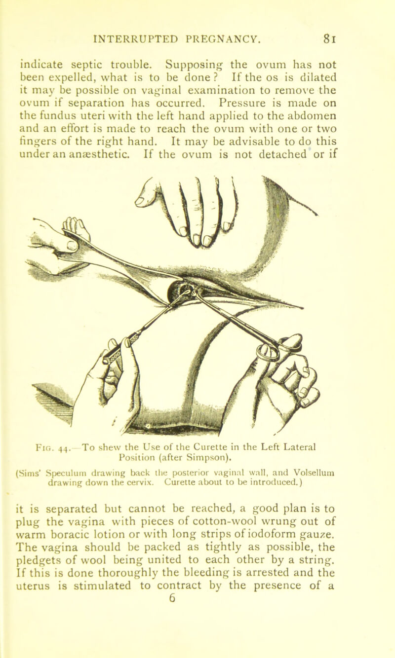 indicate septic trouble. Supposing the ovum has not been expelled, what is to be done ? If the os is dilated it may be possible on vaginal examination to remove the ovum if separation has occurred. Pressure is made on the fundus uteri with the left hand applied to the abdomen and an effort is made to reach the ovum with one or two fingers of the right hand. It may be advisable to do this under an anaesthetic. If the ovum is not detached or if Fig. 44. To shew the Use of the Curette in the Left Lateral Position (after Simpson). (Sims’ Speculum drawing back the posterior vaginal wall, and Volsellum drawing down the cervix. Curette about to be introduced.) it is separated but cannot be reached, a good plan is to plug the vagina with pieces of cotton-wool wrung out of warm boracic lotion or with long strips of iodoform gauze. The vagina should be packed as tightly as possible, the pledgets of wool being united to each other by a string. If this is done thoroughly the bleeding is arrested and the uterus is stimulated to contract by the presence of a 6