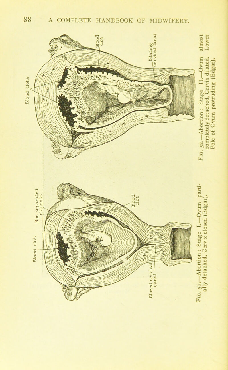 F,G- 51.—Abortion : Stage L-Ovu1 parti- Fig. 5a.-Abortion : Stage II.—Ovum almost ally detached, Cervix closed (Edgar). completely detached, Cervix dilated. Lower Pole of Ovum protruding (Edgar).