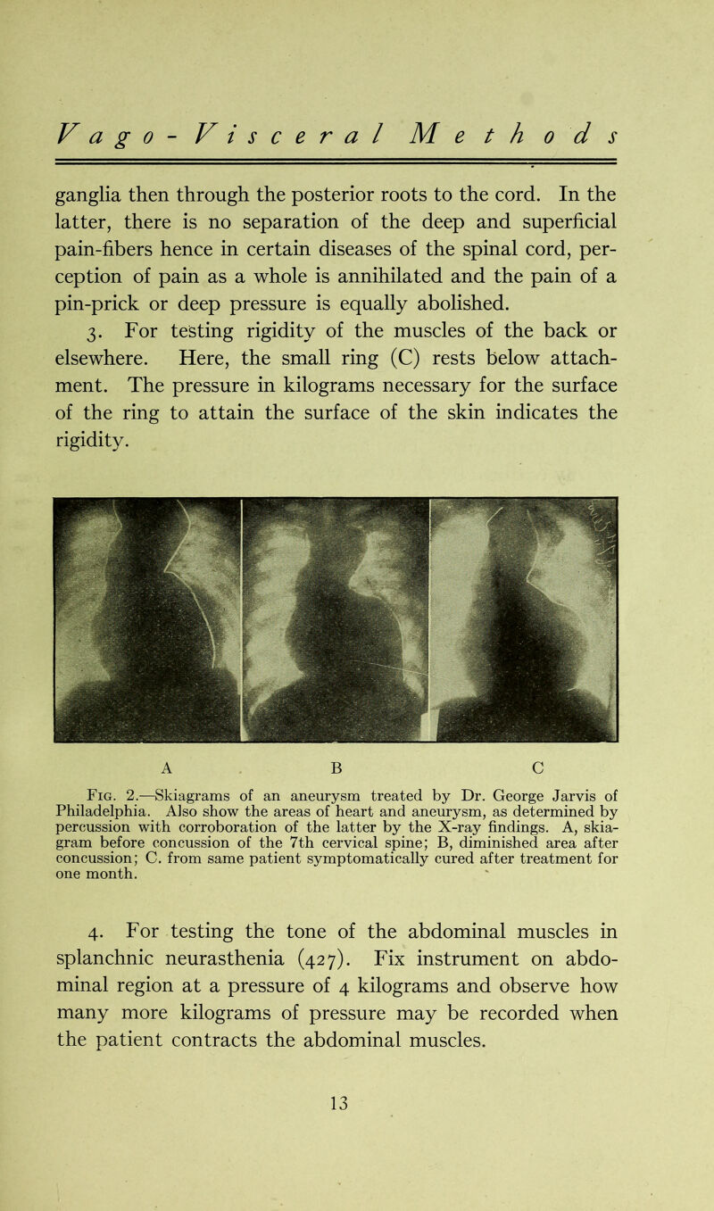 V a g o - V i s c e r a l M e t h o d s ganglia then through the posterior roots to the cord. In the latter, there is no separation of the deep and superficial pain-fibers hence in certain diseases of the spinal cord, per- ception of pain as a whole is annihilated and the pain of a pin-prick or deep pressure is equally abolished. 3. For testing rigidity of the muscles of the back or elsewhere. Here, the small ring (C) rests below attach- ment. The pressure in kilograms necessary for the surface of the ring to attain the surface of the skin indicates the rigidity. A B C Fig. 2.—Skiagrams of an aneurysm treated by Dr. George Jarvis of Philadelphia. Also show the areas of heart and aneurysm, as determined by percussion with corroboration of the latter by the X-ray findings. A, skia- gram before concussion of the 7th cervical spine; B, diminished area after concussion; C. from same patient symptomatically cured after treatment for one month. 4. For testing the tone of the abdominal muscles in splanchnic neurasthenia (427). Fix instrument on abdo- minal region at a pressure of 4 kilograms and observe how many more kilograms of pressure may be recorded when the patient contracts the abdominal muscles.