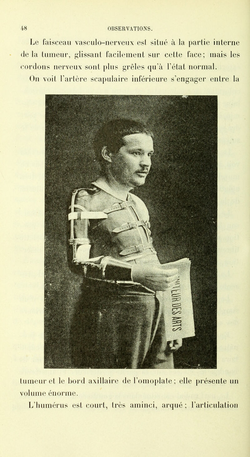 Le faisceau vasculo-nerveux est situé à la partie interne delà tumeur, glissant facilement sur cette face; mais les cordons nerveux sont plus grêles qu’à l’état normal. On voit l’artère scapulaire inférieure s’engager entre la tumeur et le bord axillaire de l’omoplate; elle présente un volume énorme. L’humérus est court, très aminci, arqué ; l’articulation