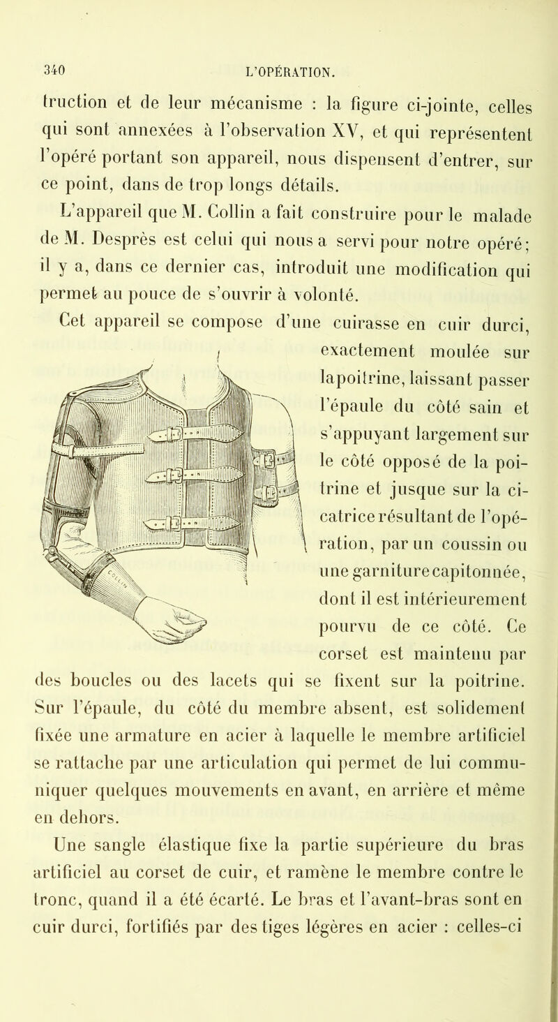 fruction et de leur mécanisme : la figure ci-jointe, celles qui sont annexées à l’observation XY, et qui représentent l’opéré portant son appareil, nous dispensent d’entrer, sur ce point, dans de trop longs détails. L’appareil que M. Collin a fait construire pour le malade deM. Desprès est celui qui nous a servi pour notre opéré; il y a, dans ce dernier cas, introduit une modification qui permet au pouce de s’ouvrir à volonté. Cet appareil se compose d’une cuirasse en cuir durci, exactement moulée sur lapoitrine, laissant passer l’épaule du côté sain et s’appuyant largement sur le côté opposé de la poi- trine et jusque sur la ci- catrice résultant de l’opé- ration, par un coussin ou une garniture capitonnée, dont il est intérieurement pourvu de ce côté. Ce corset est maintenu par des boucles ou des lacets qui se fixent sur la poitrine. Sur l’épaule, du côté du membre absent, est solidement fixée une armature en acier à laquelle le membre artificiel se rattache par une articulation qui permet de lui commu- niquer quelques mouvements en avant, en arrière et même en dehors. Une sangle élastique fixe la partie supérieure du bras artificiel au corset de cuir, et ramène le membre contre le tronc, quand il a été écarté. Le bras et l’avant-bras sont en cuir durci, fortifiés par des tiges légères en acier : celles-ci