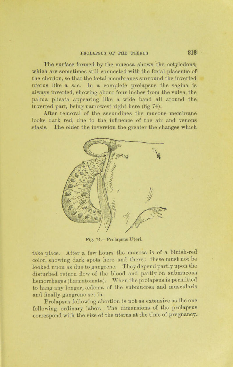 The surface formed by the mucosa shows the cotyledons, which are sometimes still connected with the foetal placentae of the chorion, so that the foetal membranes surround the inverted uterus like a sac. In a complete prolapsus the vagina is always inverted, showing about four inches from the vulva, the palma plicata appearing like a wide band all around the inverted part, being narrowest right here (fig 74). After removal of the secundines the mucous membrane looks dark red, due to the influence of the air and venous stasis. The older the inversion the greater the changes which Fig. 74.—Prolapsus Uteri. take place. After a few flours tfle mucosa is of a bluisli-red color, sflowing dark spots flere and tflere ; tflese must not be looked upon as due to gangrene. Tfley depend partly upon tfle disturbed return flow of tfle blood and partly on submucous flemorrflages (hsematomata). When the prolapsus is permitted to hang any longer, oedema of the submucosa and muscularis and finally gangrene set in. Pi’olapsus following abortion is not as extensive as the one following ordinary labor. The dimensions of the prolapsus ■correspond with the size of tfle uterus at tfle time of pregnancy.