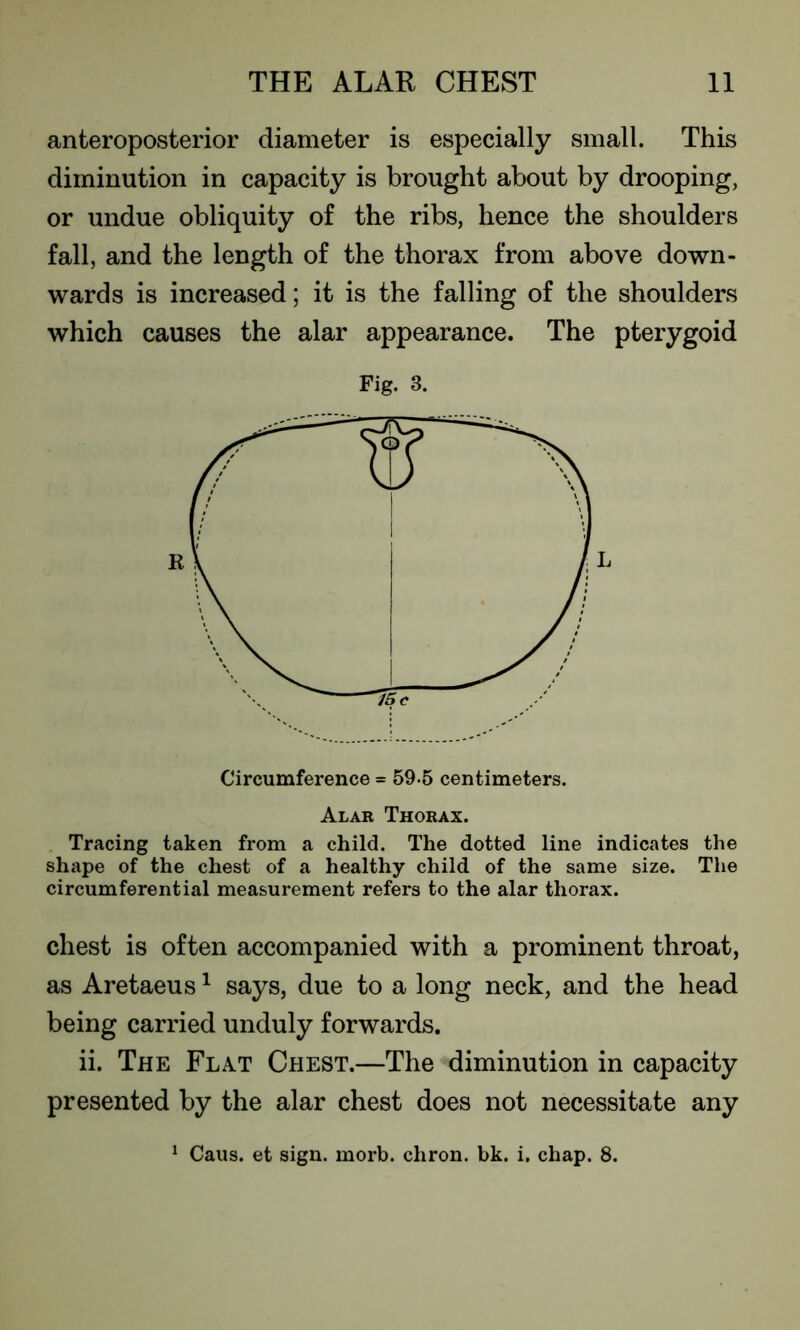 anteroposterior diameter is especially small. This diminution in capacity is brought about by drooping, or undue obliquity of the ribs, hence the shoulders fall, and the length of the thorax from above down- wards is increased; it is the falling of the shoulders which causes the alar appearance. The pterygoid Fig. 3. Circumference = 59-5 centimeters. Alar Thorax. Tracing taken from a child. The dotted line indicates the shape of the chest of a healthy child of the same size. The circumferential measurement refers to the alar thorax. chest is often accompanied with a prominent throat, as Aretaeus1 says, due to a long neck, and the head being carried unduly forwards. ii. The Flat Chest.—The diminution in capacity presented by the alar chest does not necessitate any 1 Caus. et sign. morb. chron. bk. i. chap. 8.