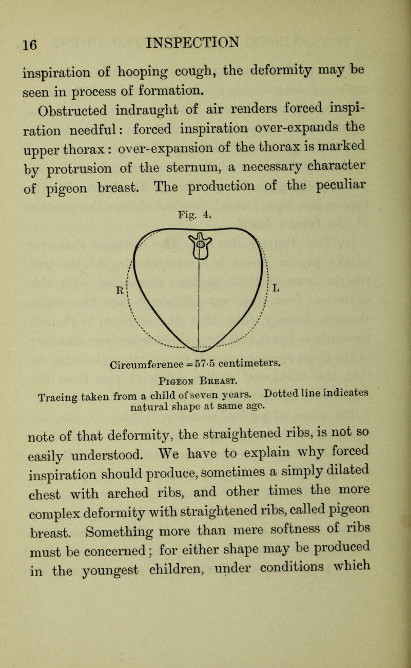 inspiration of hooping cough, the deformity may be seen in process of formation. Obstructed indraught of air renders forced inspi- ration needful: forced inspiration over-expands the upper thorax: over-expansion of the thorax is marked by protrusion of the sternum, a necessary character of pigeon breast. The production of the peculiar Fig. 4. Circumference = 57-5 centimeters. Pigeon Breast. Tracing taken from a child of seven years. Dotted line indicates natural shape at same age. note of that deformity, the straightened ribs, is not so easily understood. We have to explain why forced inspiration should produce, sometimes a simply dilated chest with arched ribs, and other times the more complex deformity with straightened ribs, called pigeon breast. Something more than mere softness of ribs must be concerned; for either shape may be produced in the youngest children, under conditions which