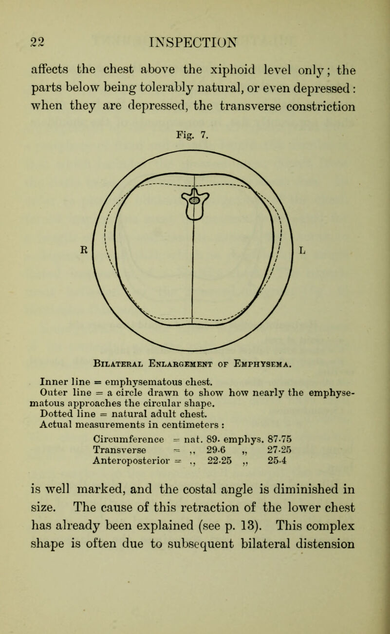 affects the chest above the xiphoid level only; the parts below being tolerably natural, or even depressed : when they are depressed, the transverse constriction Fig. 7. Bilateral Enlargement of Emphysema. Inner line = emphysematous chest. Outer line = a circle drawn to show how nearly the emphyse- matous approaches the circular shape. Dotted line = natural adult chest. Actual measurements in centimeters : Circumference = nat. 89. emphys. 87-75 Transverse - ,, 29-6 „ 27-25 Anteroposterior = ,, 22-25 „ 25-4 is well marked, and the costal angle is diminished in size. The cause of this retraction of the lower chest has already been explained (see p. 13). This complex shape is often due to subsequent bilateral distension