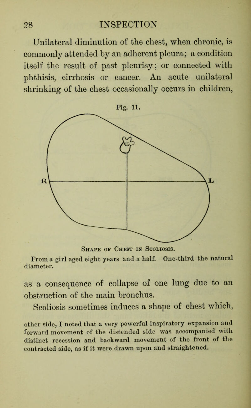 Unilateral diminution of the chest, when chronic, is commonly attended by an adherent pleura; a condition itself the result of past pleurisy; or connected with phthisis, cirrhosis or cancer. An acute unilateral shrinking of the chest occasionally occurs in children, Fig. ll. From a girl aged eight years and a half. One-third the natural diameter. as a consequence of collapse of one lung due to an obstruction of the main bronchus. Scoliosis sometimes induces a shape of chest which, other side, I noted that a very powerful inspiratory expansion and forward movement of the distended side was accompanied with distinct recession and backward movement of the front of the contracted side, as if it were drawn upon and straightened.