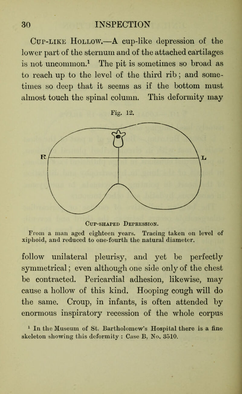 Cup-like Hollow.—A cup-like depression of the lower part of the sternum and of the attached cartilages is not uncommon.1 The pit is sometimes so broad as to reach up to the level of the third rib; and some- times so deep that it seems as if the bottom must almost touch the spinal column. This deformity may Fig. 12. Cup-shaped Depression. From a man aged eighteen years. Tracing taken on level of xiphoid, and reduced to one-fourth the natural diameter. follow unilateral pleurisy, and yet be perfectly symmetrical; even although one side only of the chest be contracted. Pericardial adhesion, likewise, may cause a hollow of this kind. Hooping cough will do the same. Croup, in infants, is often attended by enormous inspiratory recession of the whole corpus 1 In the Museum of St. Bartholomew’s Hospital there is a fine skeleton showing this deformity : Case B, No. 3510.
