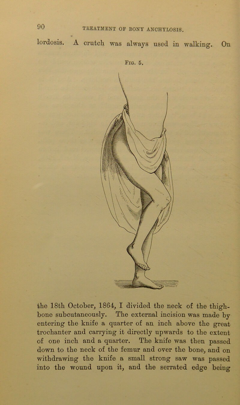 lordosis. A crutch was always used in walking. On Fra. 5. the 18th October, 1864, I divided the neck of the thigh- bone subcutaneously. The external incision was made by entering the knife a quarter of an inch above the great trochanter and carrying it directly upwards to the extent of one inch and a quarter. The knife was then passed down to the neck of the femur and over the bone, and on withdrawing the knife a small strong saw was passed into the wound upon it, and the serrated edge being
