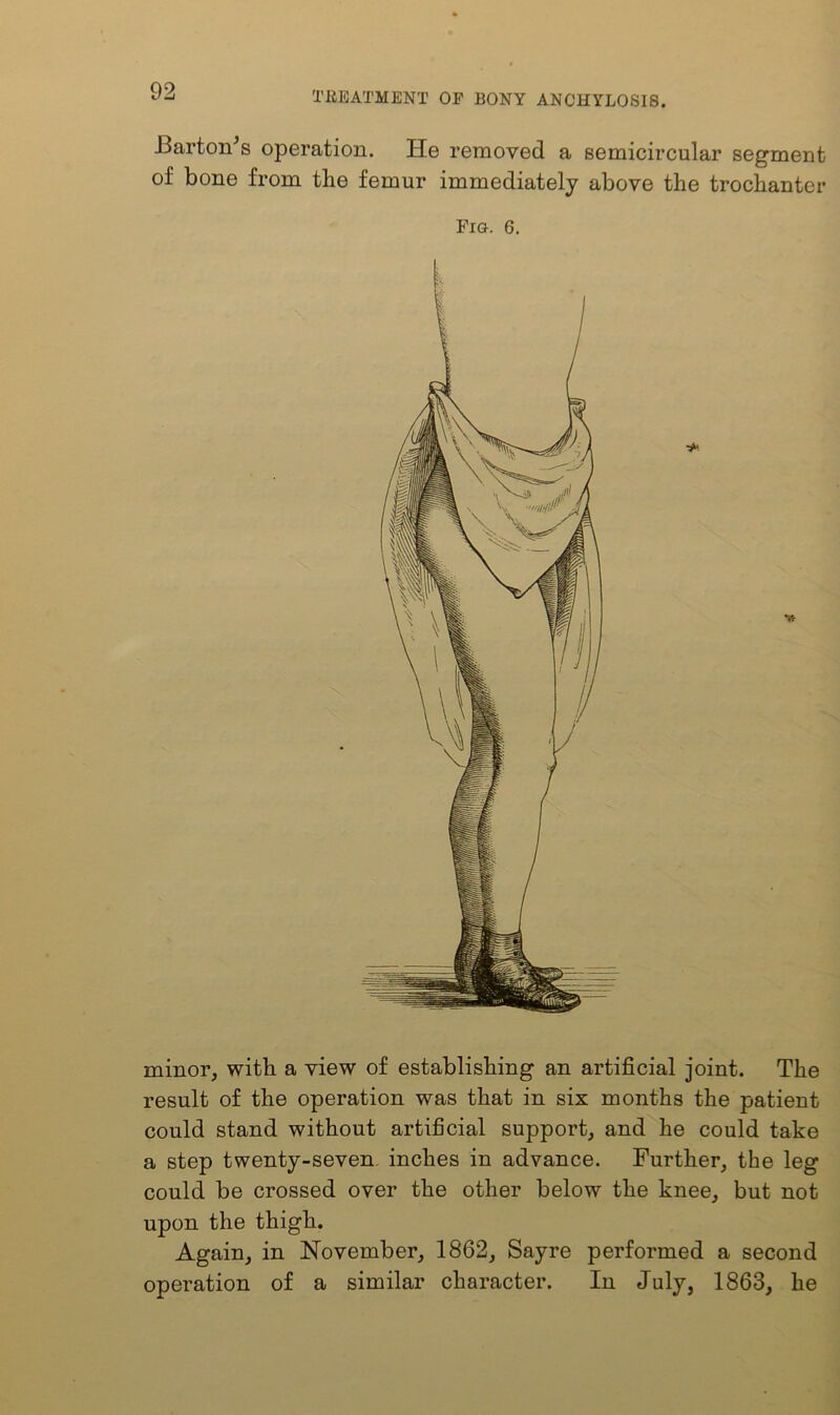 BartoAs operation. He removed a semicircular segment of bone from the femur immediately above the trochanter Fig. 6. minor, with a view of establishing an artificial joint. The result of the operation was that in six months the patient could stand without artificial support, and he could take a step twenty-seven inches in advance. Further, the leg could be crossed over the other below the knee, but not upon the thigh. Again, in November, 1862, Sayre performed a second operation of a similar character. In July, 1863, he