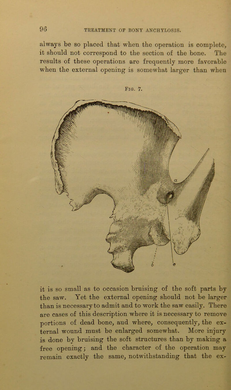 always be so placed that when the operation is complete, it should not correspond to the section of the bone. The results of these operations are frequently more favorable when the external opening is somewhat larger than when Frn. 7. it is so small as to occasion bruising of the soft parts by the saw. Yet the external opening should not be larger than is necessary to admit and to work the saw easily. There are cases of this description where it is necessary to remove portions of dead bone, aud where, consequently, the ex- ternal wound must be enlarged somewhat. More injury is done by bruising the soft structures than by making a free opening; and the character of the operation may remain exactly the same, notwithstanding that the ex-