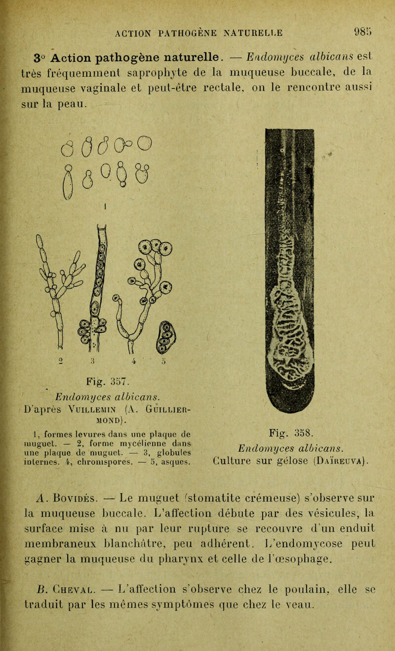 3° Action pathogène naturelle. — Endomyces albicans est très fréquemment saprophyte de la muqueuse buccale, de la muqueuse vaginale et peut-être rectale, on le rencontre aussi sur la peau. A. Bovidés. — Le muguet (stomatite crémeuse) s’observe sur la muqueuse buccale. L’affection débute par des vésicules, la surface mise à nu par leur rupture se recouvre d'un enduit membraneux blanchâtre, peu adhérent. L’endomycose peut gagner la muqueuse du pharynx et celle de l’œsophage. B. Cheval. — L’affection s’observe chez le poulain, elle se traduit par les mêmes symptômes que chez le veau. Fig. 357. Endomyces albicans. D’après Vuillemin (A. GÜillier- mond). ô 0ÔO°O 1, formes levures dans une plaque de muguet. — 2, forme mycélienne dans une plaque de muguet. — 3, globules internes. 4, chromspores. — o, asques. Fig. 358. Endomyces albicans. Culture sur gélose (Daïreuva).