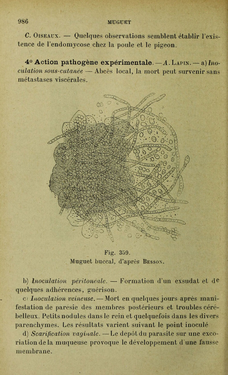 C. Oiseaux. — Quelques observations semblent établir l’exis- tence de l’endomycose chez la poule et le pigeon. 4° Action pathogène expérimentale. —A. Lapin. — a) Ino- culation nous-eut a née — Abcès local, la mort peut survenir sans métastases viscérales. Fig. 359. Muguet buccal, d’après Besson. b) Inoculation péritonéale. — Formation d’un exsudât et de quelques adhérences, guérison. ci Inoculation veineuse. — Mort en quelques jours après mani- festation de parésie des membres postérieurs et troubles céré- belleux. Petits nodules dans le rein et quelquefois dans les divers parenchymes. Les résultats varient suivant le point inoculé d) Scarification vaginale. —Le dépôt du parasite sur une exco- riation de la muqueuse provoque le développement d une fausse membrane.