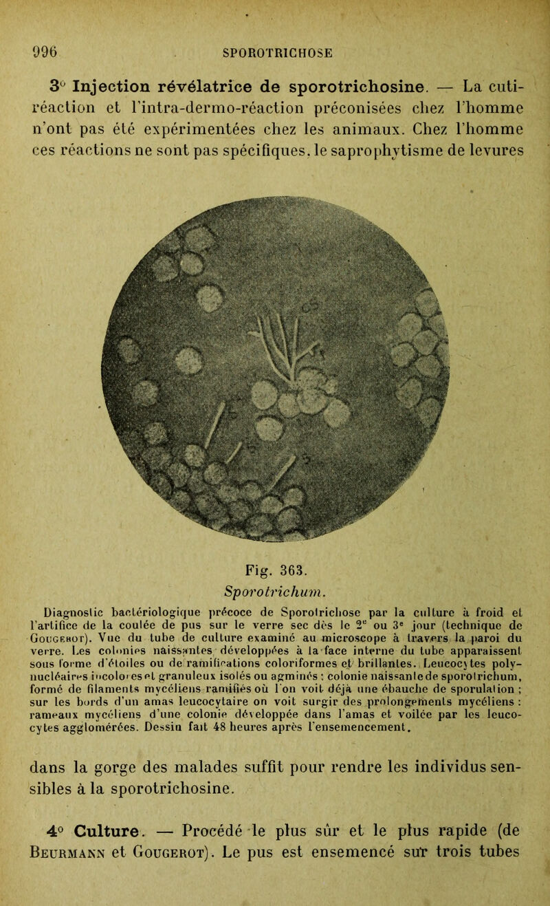 3° Injection révélatrice de sporotrichosine. — La cuti- réaction et l’intra-dermo-réaction préconisées chez l’homme n’ont pas été expérimentées chez les animaux. Chez l’homme ces réactions ne sont pas spécifiques, le saprophytisme de levures Fig. 363. Sporo trie hum. Diagnostic bactériologique précoce de Sporolricliosc par la culture à froid et l’artifice de la coulée de pus sur le verre sec dès le 2U ou 3e jour (technique de Gougehot). Vue du tube de culture examiné au microscope à travers la paroi du verre. Les colonies naissantes développées à la face interne du tube apparaissent sous forme d'étoiles ou de ramifications coloriformes et brillantes. Leucocytes poly- nucléaires incoloresel granuleux isolés ou agminés : colonie naissanlcde sporolrichum, formé de filaments mycéliens ramifiés où l'on voit déjà une ébauche de sporulation ; sur les bords d’un amas leucocytaire on voit surgir des prolongements mycéliens: rameaux mycéliens d’une colonie développée dans l'amas et voilée par les leuco- cytes agglomérées. Dessin fait 48 heures après l’ensemencement. dans la gorge des malades suffit pour rendre les individus sen- sibles à la sporotrichosine. 4° Culture. — Procédé le plus sûr et le plus rapide (de Beurmann et Gougerot). Le pus est ensemencé sut* trois tubes