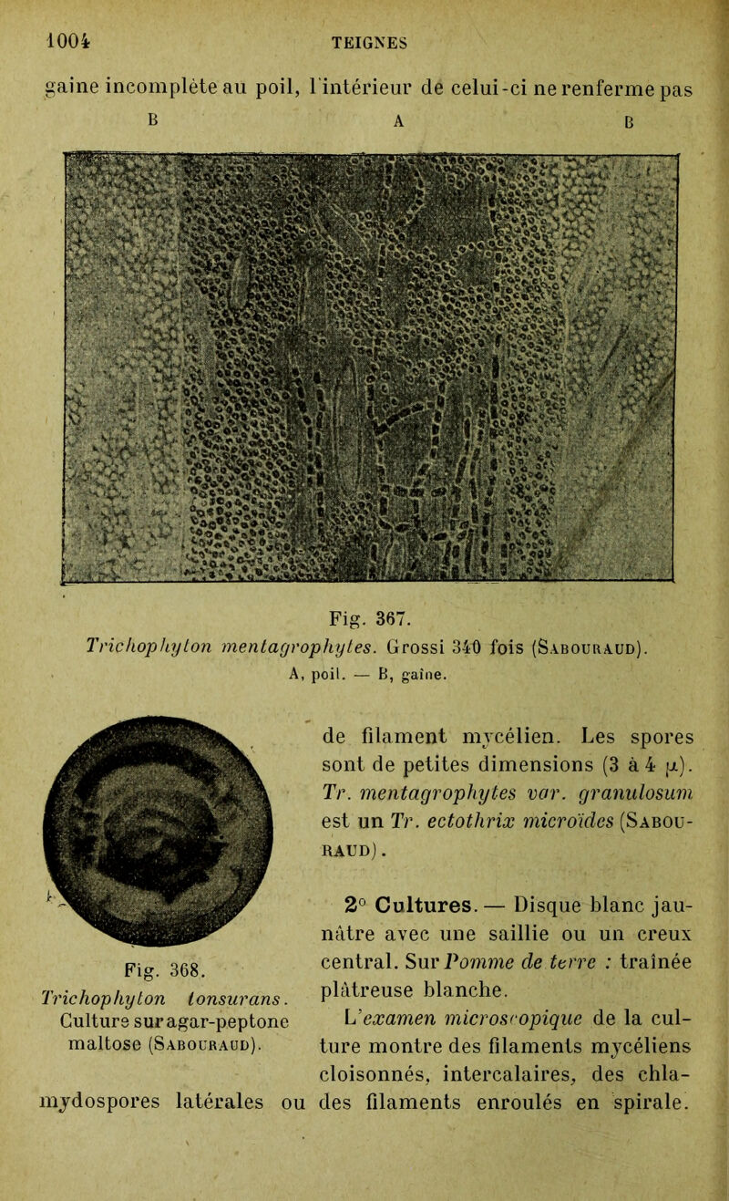 gaine incomplète au poil, l'intérieur de celui-ci ne renferme pas Trickophyton mentagrophytes. Grossi 341) fois (Sa.boura.ud). A, poil. — B, gaine. de filament mycélien. Les spores sont de petites dimensions (3 à 4 p). Tr. mentagrophytes vor. granulosum est un Tr. ectothrix microides (Sabou- raud) . 2° Cultures.— Disque blanc jau- nâtre avec une saillie ou un creux central. Sur Pomme de terre : traînée plâtreuse blanche. L’examen microscopique de la cul- ture montre des filaments mycéliens cloisonnés, intercalaires, des chla- mydospores latérales ou des filaments enroulés en spirale. Fig. 368. Trichophyton tonsurans. Culture suragar-peptone maltose (Sabouraud).