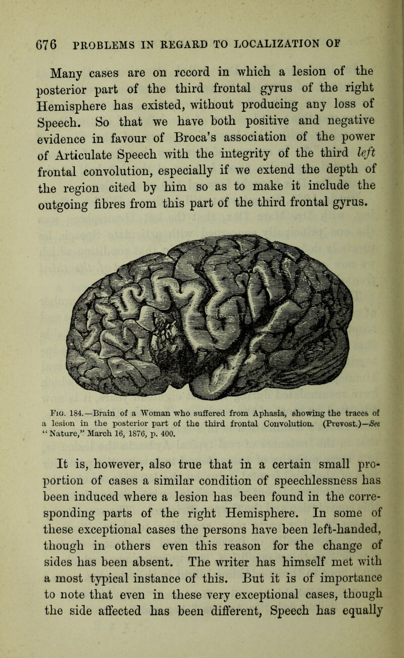 Many cases are on record in wliich a lesion of the posterior part of the third frontal gyrus of the right Hemisphere has existed, without producing any loss of Speech. So that we have both positive and negative evidence in favour of Broca’s association of the power of Articulate Speech with the integrity of the third left frontal convolution, especially if we extend the depth of the region cited by him so as to make it include the outgoing fibres from this part of the third frontal gyrus. Fia. 184.—Brain of a Woman who suffered from Aphasia, showing the traces of a lesion in the posterior part of the third frontal Convolution. (Prevost.)—(See “ Nature,’' March 16, 1876, p. 400. It is, however, also true that in a certain small pro- portion of cases a similar condition of speechlessness has been induced where a lesion has been found in the corre- sponding parts of the right Hemisphere. In some of these exceptional cases the persons have been left-handed, though in others even this reason for the change of sides has been absent. The writer has himself met with a most typical instance of this. But it is of importance to note that even in these very exceptional cases, though the side affected has been different, Speech has equally