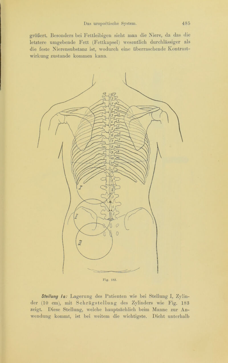 größert. Besonders bei Fettleibigen sieht man die Niere, da das die letztere umgebende Fett (Fettkapsel) 'svesentlicli durchlässiger als die feste Nierensubstanz ist, wodurch eine überi’aschende Kontrast- wirkung zustande kommen kann. Stellung la: Lagerung des Patienten wie bei Stellung 1, Zylin- der (10 cm), mit Schrägstellung des Zylinders wie Fig. 183 zeigt. Diese Stellung, tvelche hauptsächlich beim INIanne zur An- wendung kommt, ist bei weitem die wichtigste. Dicht unterhalb