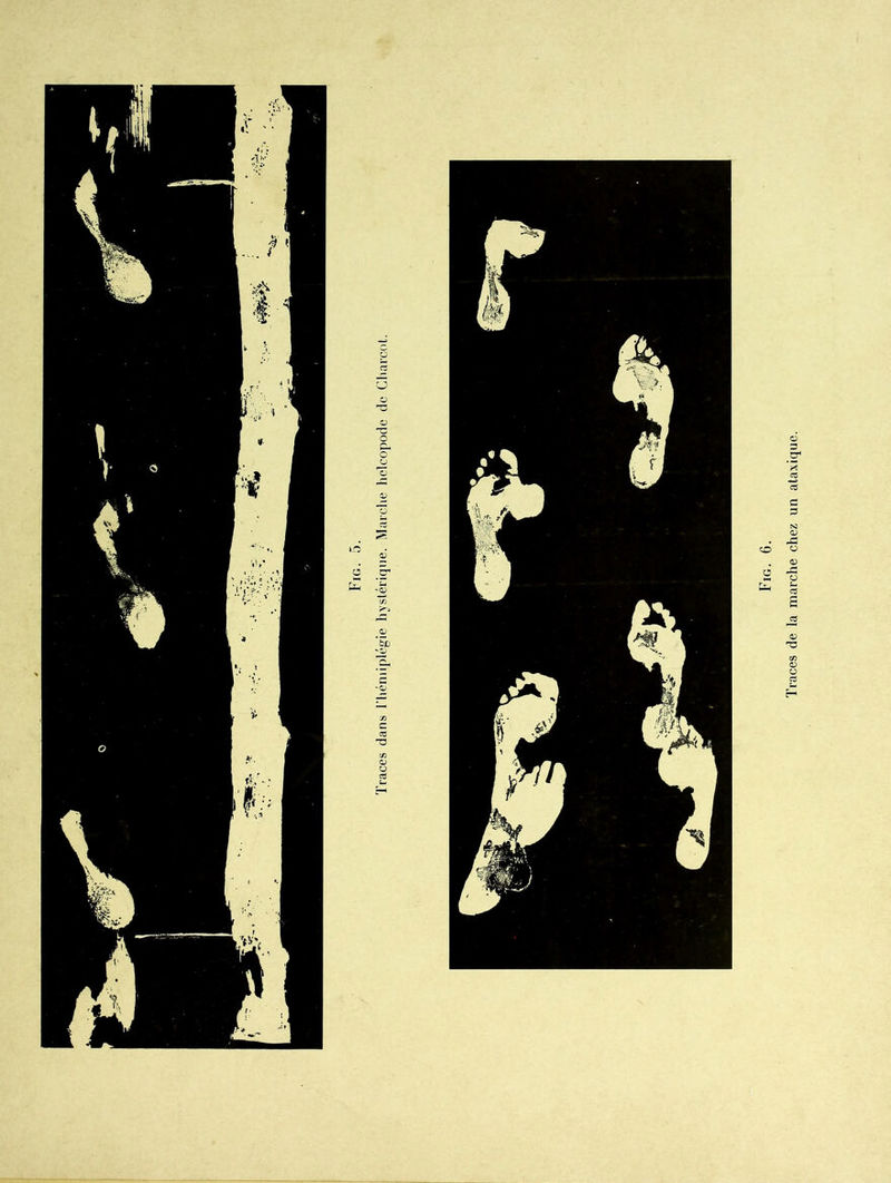 Fig. G. Traces de la marche chez un ataxique.