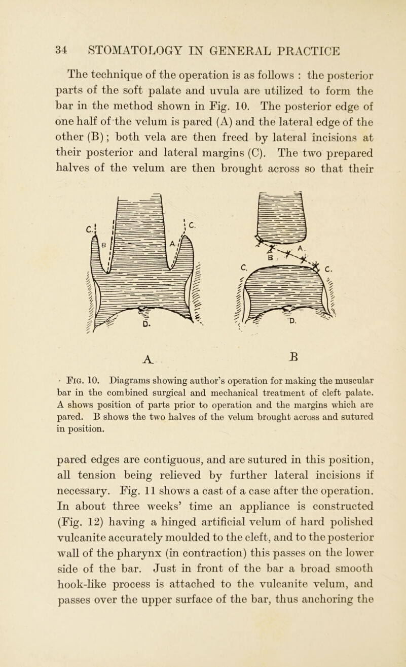 The technique of the operation is as follows : the posterior parts of the soft palate and uvula are utilized to form the bar in the method shown in Fig. 10. The posterior edge of one half of the velum is pared (A) and the lateral edge of the other (B); both vela are then freed by lateral incisions at their posterior and lateral margins (C). The two prepared halves of the velum are then brought across so that their ' Fig. 10. Diagrams showing author’s operation for making the muscular bar in the combined surgical and mechanical treatment of cleft palate. A shows position of parts prior to operation and the margins which are pared. B shows the two halves of the velum brought across and sutured in position. pared edges are contiguous, and are sutured in this position, all tension being relieved by further lateral incisions if necessary. Eig. 11 shows a cast of a case after the operation. In about three weeks’ time an appliance is constructed (Eig. 12) having a hinged artificial velum of hard polished vulcanite accurately moulded to the cleft, and to the posterior wall of the pharynx (in contraction) this passes on the lower side of the bar. Just in front of the bar a broad smooth hook-like process is attached to the vulcanite velum, and passes over the upper surface of the bar, thus anchoring the