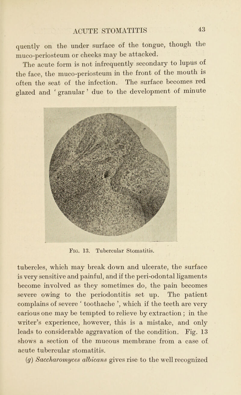 quently on the under surface of the tongue, though the muco-periosteum or cheeks may be attacked. The acute form is not infrequently secondary to lupus of the face, the muco-periosteum in the front of the mouth is often the seat of the infection. The surface becomes red glazed and f granular ’ due to the development of minute Fig. 13. Tubercular Stomatitis. tubercles, which may break down and ulcerate, the surface is very sensitive and painful, and if the peri-odontal ligaments become involved as they sometimes do, the pain becomes severe owing to the periodontitis set up. The patient complains of severe f toothache ’, which if the teeth are very carious one may be tempted to relieve by extraction ; in the writer’s experience, however, this is a mistake, and only leads to considerable aggravation of the condition. Fig. 13 shows a section of the mucous membrane from a case of acute tubercular stomatitis. (g) Saccharomyces albicans gives rise to the well recognized