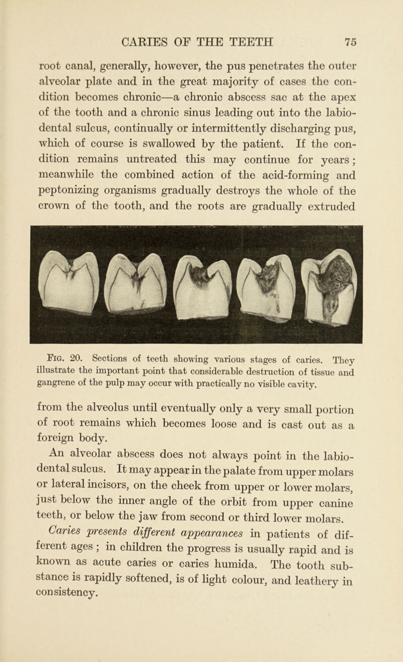 root canal, generally, however, the pus penetrates the outer alveolar plate and in the great majority of cases the con- dition becomes chronic—a chronic abscess sac at the apex of the tooth and a chronic sinus leading out into the labio- dental sulcus, continually or intermittently discharging pus, which of course is swallowed by the patient. If the con- dition remains untreated this may continue for years; meanwhile the combined action of the acid-forming and peptonizing organisms gradually destroys the whole of the crown of the tooth, and the roots are gradually extruded Fig. 20. Sections of teeth showing various stages of caries. They illustrate the important point that considerable destruction of tissue and gangrene of the pulp may occur with practically no visible cavity. from the alveolus until eventually only a very small portion of root remains which becomes loose and is cast out as a foreign body. An alveolar abscess does not always point in the labio- dental sulcus. It may appear in the palate from upper molars or lateral incisors, on the cheek from upper or lower molars, just below the inner angle of the orbit from upper canine teeth, or below the jaw from second or third lower molars. Caries presents different appearances in patients of dif- ferent ages ; in children the progress is usually rapid and is known as acute caries or caries liumida. The tooth sub- stance is rapidly softened, is of light colour, and leathery in consistency.