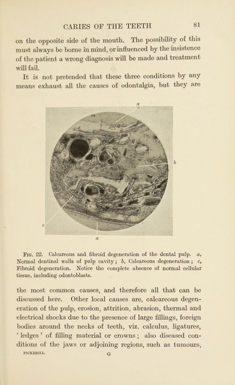 on the opposite side of the mouth. The possibility of this must always be borne in mind, or influenced by the insistence of the patient a wrong diagnosis will be made and treatment will fail. It is not pretended that these three conditions by any means exhaust all the causes of odontalgia, but they are Fig. 22. Calcareous and fibroid degeneration of the dental pulp, a, Normal dentinal walls of pulp cavity; b, Calcareous degeneration ; c, Fibroid degeneration. Notice the complete absence of normal cellular tissue, including odontoblasts. the most common causes, and therefore all that can be discussed here. Other local causes are, calcareous degen- eration of the pulp, erosion, attrition, abrasion, thermal and electrical shocks due to the presence of large fillings, foreign bodies around the necks of teeth, viz. calculus, ligatures, ‘ ledges 5 of filling material or crowns ; also diseased con- ditions of the jaws or adjoining regions, such as tumours, PICKERILL G