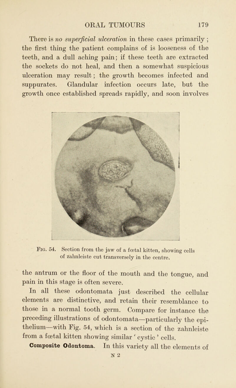 There is no superficial ulceration in these cases primarily ; the first thing the patient complains of is looseness of the teeth, and a dull aching pain; if these teeth are extracted the sockets do not heal, and then a somewhat suspicious ulceration may result; the growth becomes infected and suppurates. Glandular infection occurs late, but the growth once established spreads rapidly, and soon involves Fig. 54. Section from the jaw of a foetal kitten, showing cells of zahnleiste cut transversely in the centre. the antrum or the floor of the mouth and the tongue, and pain in this stage is often severe. In all these odontomata just described the cellular elements are distinctive, and retain their resemblance to those in a normal tooth germ. Compare for instance the preceding illustrations of odontomata—particularly the epi- thelium—with Fig. 54, which is a section of the zahnleiste from a foetal kitten showing similar c cystic ’ cells. Composite Odontoma. In this variety all the elements of