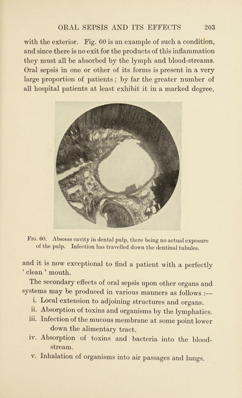 with the exterior. Fig. 60 is an example of such a condition, and since there is no exit for the products of this inflammation they must all be absorbed by the lymph and blood-streams. Oral sepsis in one or other of its forms is present in a very large proportion of patients; by far the greater number of all hospital patients at least exhibit it in a marked degree, Fig. 60. Abscess cavity in dental pulp, there being no actual exposure of the pulp. Infection has travelled down the dentinal tubules. and it is now exceptional to find a patient with a perfectly ‘ clean 5 mouth. The secondary effects of oral sepsis upon other organs and systems may be produced in various manners as follows :— i. Local extension to adjoining structures and organs. ii. Absorption of toxins and organisms by the lymphatics. iii. Infection of the mucous membrane at some point lower down the alimentary tract. iv. Absorption of toxins and bacteria into the blood- stream. v. Inhalation of organisms into air passages and lungs.