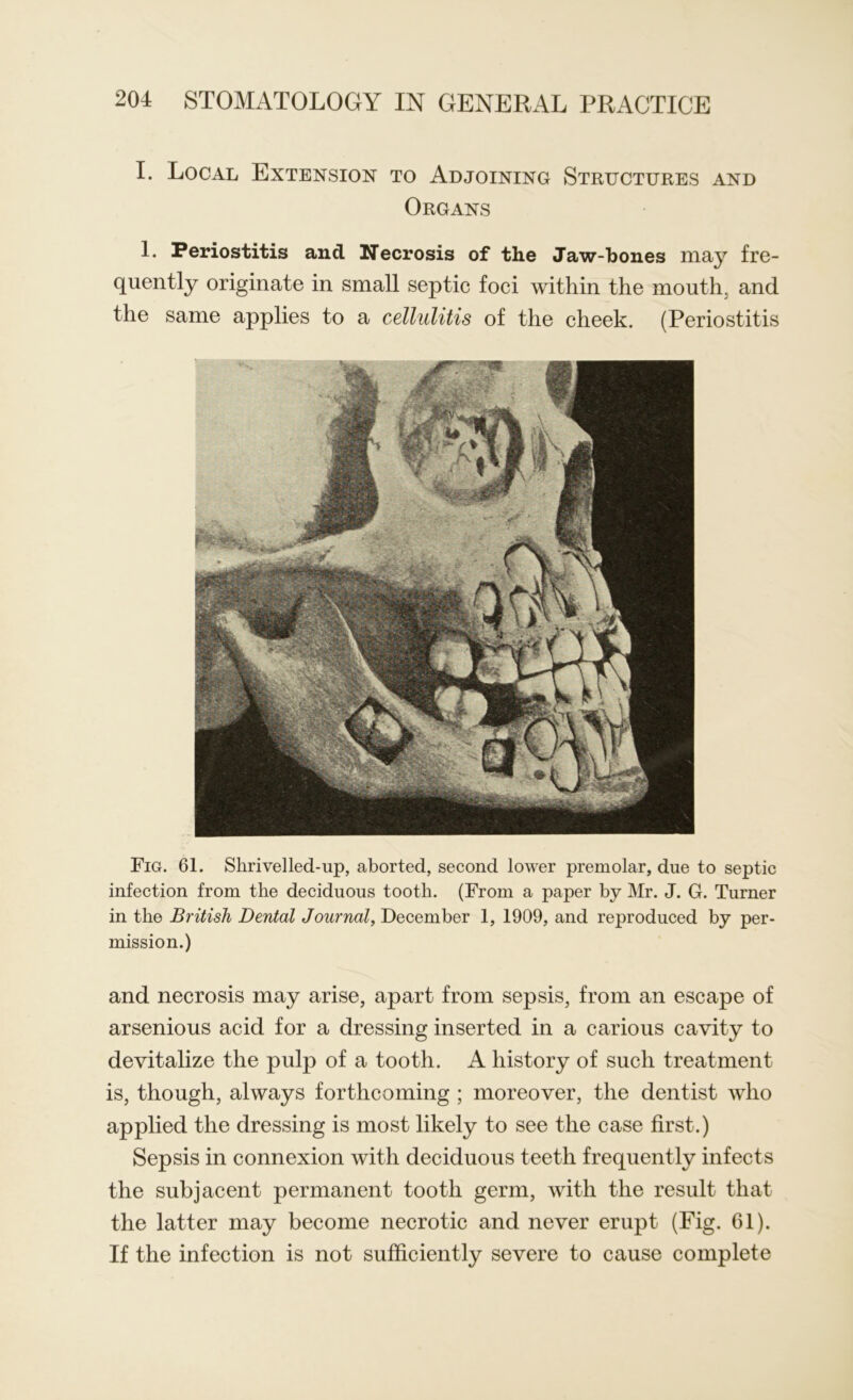 I. Local Extension to Adjoining Structures and Organs 1. Periostitis and Necrosis of the Jaw-bones may fre- quently originate in small septic foci within the mouth, and the same applies to a cellulitis of the cheek. (Periostitis Fig. 61. Shrivelled-up, aborted, second lower premolar, due to septic infection from the deciduous tooth. (From a paper by Mr. J. G. Turner in the British Dental Journal, December 1, 1909, and reproduced by per- mission.) and necrosis may arise, apart from sepsis, from an escape of arsenious acid for a dressing inserted in a carious cavity to devitalize the pulp of a tooth. A history of such treatment is, though, always forthcoming ; moreover, the dentist who applied the dressing is most likely to see the case first.) Sepsis in connexion with deciduous teeth frequently infects the subjacent permanent tooth germ, with the result that the latter may become necrotic and never erupt (Fig. 61). If the infection is not sufficiently severe to cause complete