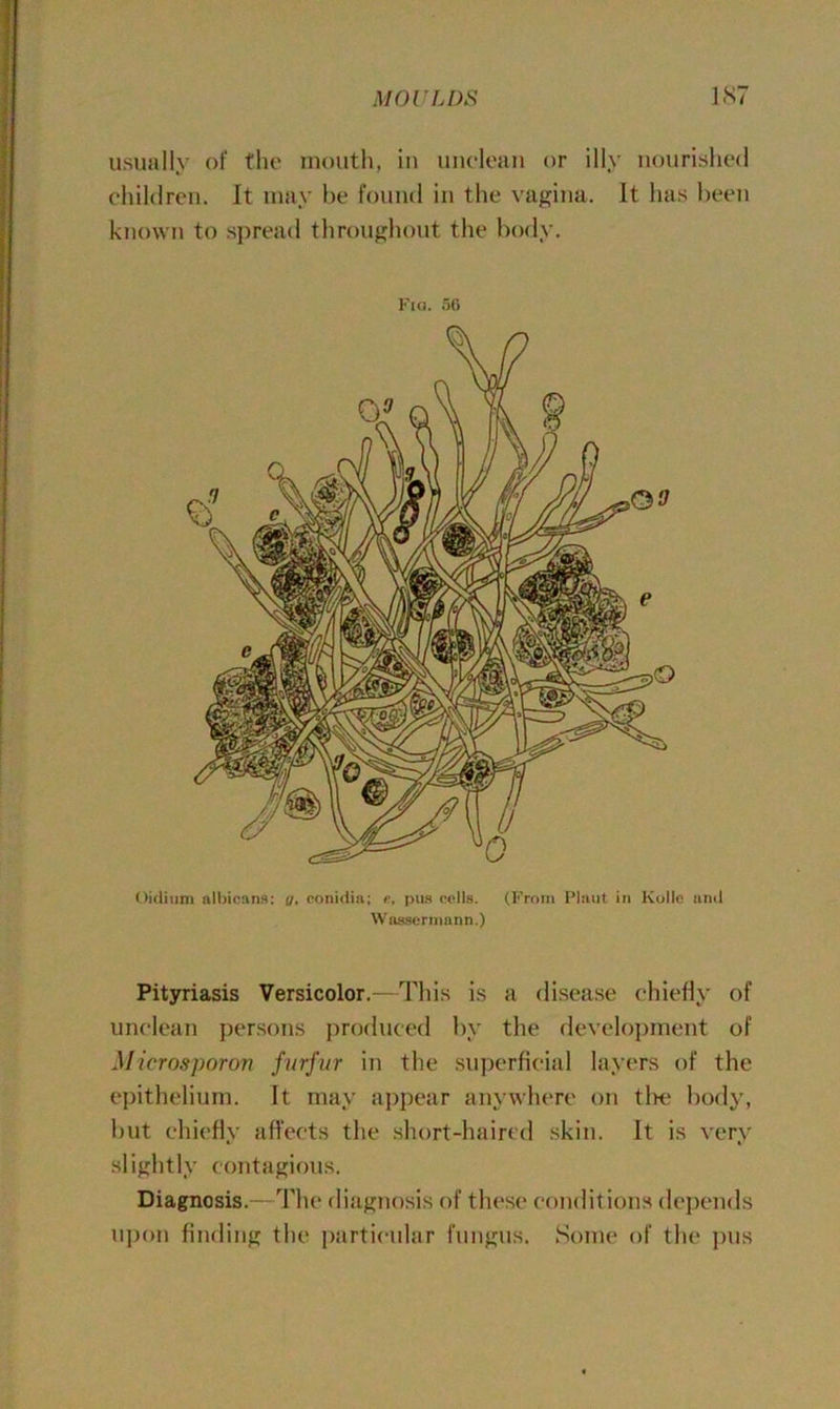 MO l' LDS 1ST usually of the mouth, in unclean or illy nourished children. It may be found in the vagina. It has been known to spread throughout the body. Fia. 50 Oidium albicans: 17. conidia; e, pus cells. (From Plant in Kollo and Wassermann.) Pityriasis Versicolor.—This is a disease chiefly of unclean persons produced by the development of Microsporon furfur in the superficial layers of the epithelium. It may appear anywhere on the body, but chiefly affects the short-haired skin. It is very slightly contagious. Diagnosis.—The diagnosis of these conditions depends upon finding the particular fungus. Some of the pus