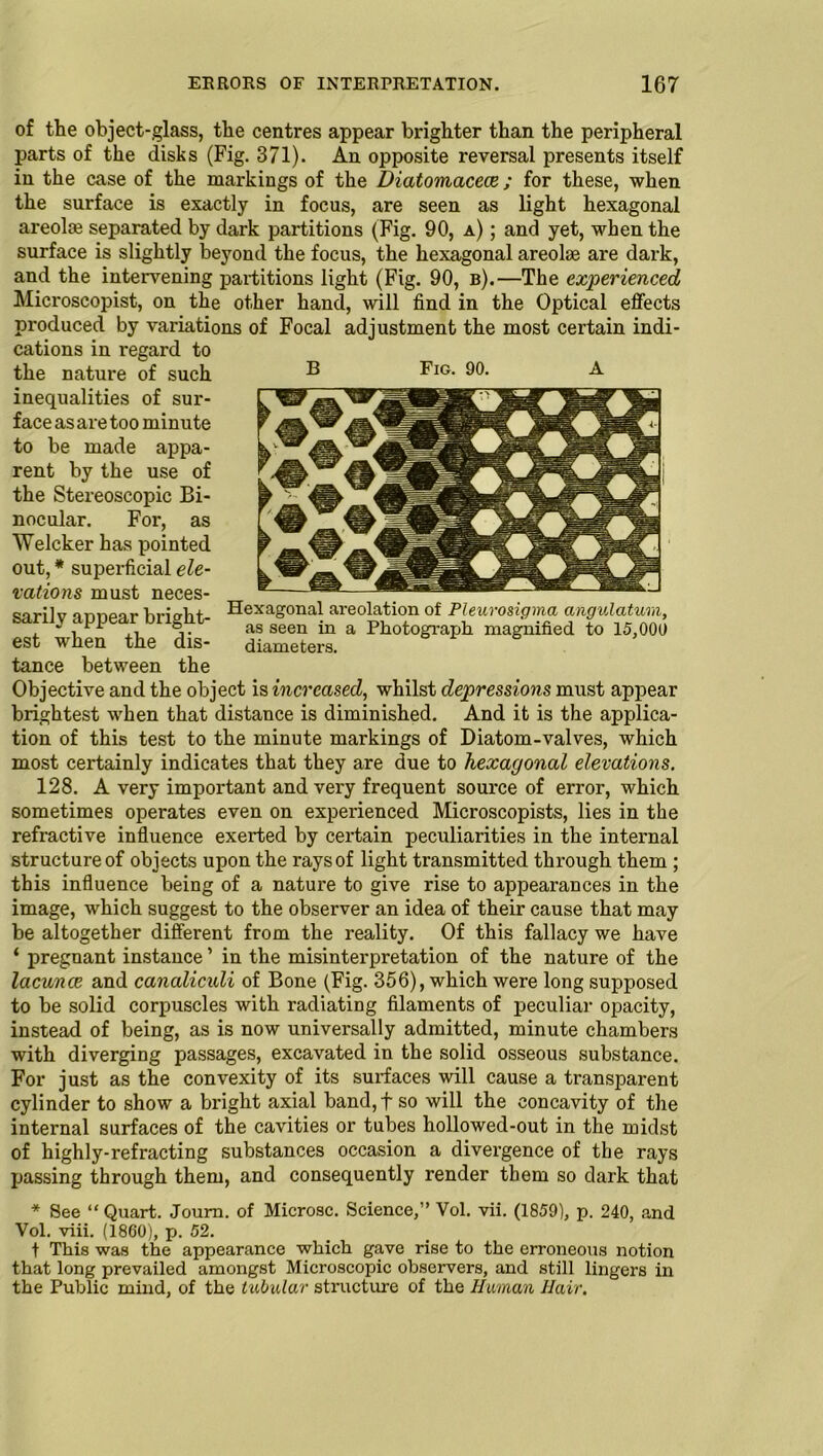 of the object-glass, the centres appear brighter than the peripheral parts of the disks (Fig. 371). An opposite reversal presents itself in the case of the markings of the Diatomacece; for these, when the surface is exactly in focus, are seen as light hexagonal areolm separated by dark partitions (Fig. 90, a) ; and yet, when the surface is slightly beyond the focus, the hexagonal areolm are dark, and the intervening partitions light (Fig. 90, b).—The experienced Microscopist, on the other hand, will find in the Optical effects produced by variations of Focal adjustment the most certain indi- cations in regard to the nature of such ® Fig. 90. A inequalities of sur- face as are too minute to be made appa- rent by the use of the Stereoscopic Bi- nocular. For, as Welcker has pointed out, * superficial ele- vations must neces- sarily appear bright- est when the dis- tance between the Objective and the object is increased, whilst depressions must appear brightest when that distance is diminished. And it is the applica- tion of this test to the minute markings of Diatom-valves, which most certainly indicates that they are due to hexagonal elevations. 128. A very important and very frequent source of error, which sometimes operates even on experienced Microscopists, lies in the refractive influence exerted by certain peculiarities in the internal structure of objects upon the rays of light transmitted through them ; this influence being of a nature to give rise to appearances in the image, which suggest to the observer an idea of their cause that may be altogether different from the reality. Of this fallacy we have ‘ pregnant instance ’ in the misinterpretation of the nature of the lacunce and canalicnli of Bone (Fig. 356), which were long supposed to be solid corpuscles with radiating filaments of peculiar opacity, instead of being, as is now universally admitted, minute chambers with diverging passages, excavated in the solid osseous substance. For just as the convexity of its surfaces will cause a transparent cylinder to show a bright axial band, f so will the concavity of the internal surfaces of the cavities or tubes hollowed-out in the midst of highly-refracting substances occasion a divergence of the rays passing through them, and consequently render them so dark that Hexagonal areolation of Pleurosigma angulatum, as seen in a Photograph magnified to 15,000 diameters. * See “ Quart. Joum. of Microsc. Science,” Vol. vii. (1859), p. 240, and Vol. viii. (1860), p. 52. t This was the appearance which gave rise to the erroneous notion that long prevailed amongst Microscopic observers, and still lingers in the Public mind, of the tubular structure of the Human Hair.