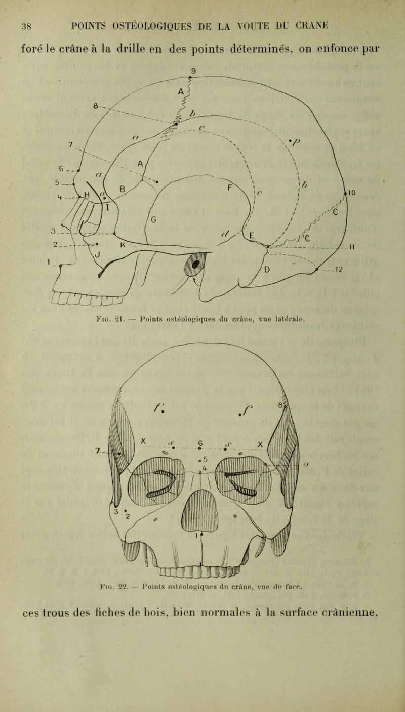 foré le crâne à la drille en des points déterminés, on enfonce par 9 ces trous des fiches de bois, bien normales à la surface crânienne,